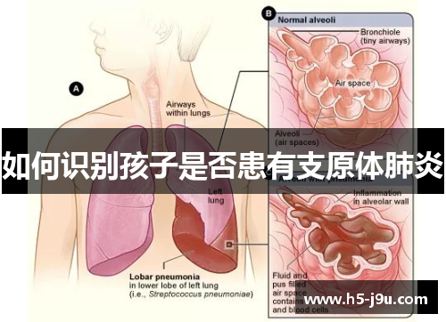 如何识别孩子是否患有支原体肺炎